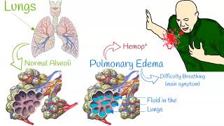 Pulmonary edema  Mechanism of action [upl. by Audie]