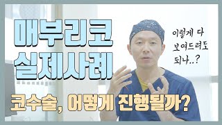 매부리 짧은코 실제 수술 사례로 보는 코성형의 모든 것 [upl. by Corbett247]