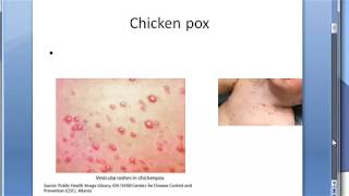 Microbiology 457 a Chicken pox VZV Varicella Zoster HHV3 Virus Difference Shingles [upl. by Artur]