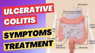 Ulcerative Colitis  Inflammatory Bowel Disease  Symptoms Diagnosis and Treatment [upl. by Ernaline221]