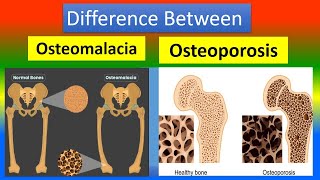 Difference Osteomalacia and Osteoporosis [upl. by Morey]