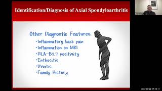 When to Suspect Ankylosing Spondylitis When a Patient Presents with Back Pain [upl. by Ritz]