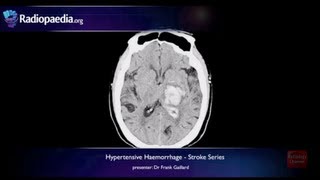 Stroke Hypertensive haemorrhage  radiology video tutorial MRI CT [upl. by Anircam]