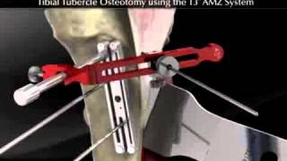 Tibial Tubercle Osteotomy using the T3 AMZ System [upl. by Kabab385]