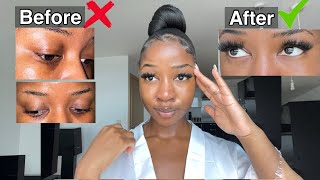 HOW TO GET RID OF DARK CIRCLES PERMANENTLY 👀 Fast and Effective [upl. by Kamerman]