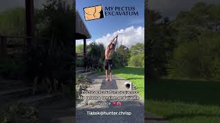 pectus excavatum exercises  concave chest [upl. by Jadwiga126]