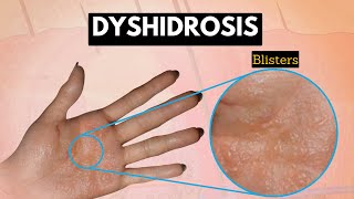 Dyshidrosis Causes Signs and Symptoms Diagnosis and Treatment [upl. by Durrej873]