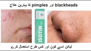 BEST TREATMENT FOR ACNE amp BLACKHEADS uses effects and side effects of isotin gel URDUHINDI [upl. by Aicssej]