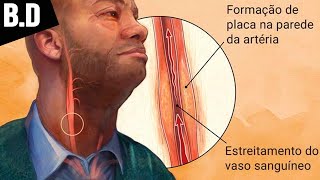 ATEROSCLEROSE – Sintomas Prevenção e Tratamento  Biologia com Patrick Gomes [upl. by Macintosh632]