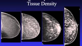 Introduction to Mammography [upl. by Nevar]