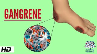 Gangrene Causes Signs and Symptoms Diagnosis and Treatment [upl. by Arracat420]