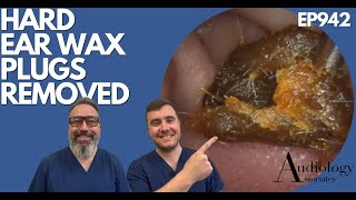 HARD EAR WAX PLUGS REMOVED  EP942 [upl. by Ortrude163]