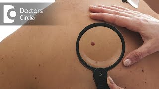 Difference between Melanoma and other skin pigmentations  Dr Rajdeep Mysore [upl. by Sidnee899]