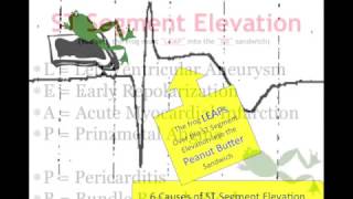 Teaching 12 Lead EKG STEMI or early repol [upl. by Alieka]