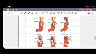 L20 Dysphagia part 2 💘 [upl. by Schaffer]