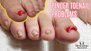 👣Pedicure Tutorial on Big Pincer Toenails that Cause Pain👣 [upl. by Nalad729]