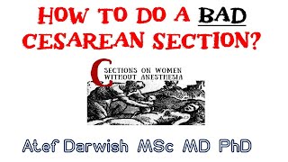 How to do a bad cesarean section [upl. by Acisey]