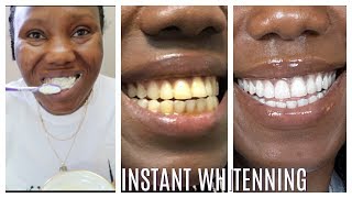 How I whitened my yellow teeth in 2 Minutes  LIVE DEMO HOME REMEDY [upl. by Akcirahs]