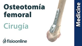 OSTEOTOMÍA FEMORAL Técnica de la artrosis de rodilla sin prótesis [upl. by Grevera]