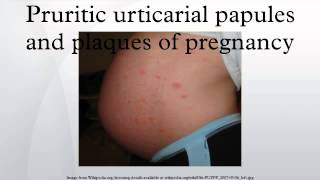 Pruritic urticarial papules and plaques of pregnancy [upl. by Lleksah]