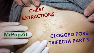 Clogged pores on the chest part 3 Blackheads ingrown hairssteatosand vellus hair cysts extracted [upl. by Cornall]