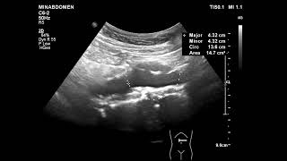 chronic rupture abdominal aortic aneurysmAAA [upl. by Einahpit]