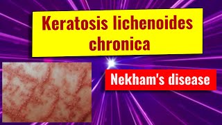 Keratosis lichenoides chronica overview causes features management [upl. by Burny278]