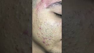 blackhead removal and treatmentbarbershop [upl. by Arahsit]