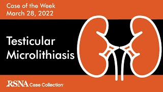 Case of the Week Testicular Microlithiasis [upl. by Urbain]