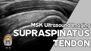 Musculoskeletal Ultrasound MSKUS Supraspinatus tendon [upl. by Timmons753]