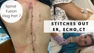 Scoliosis VLOG 7  3 Week PostOp Stitch Removal Cardiologist ER Trip [upl. by Getter]