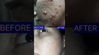 Acne Scars Before amp After Results acnescars skincare short [upl. by Euqinomod]