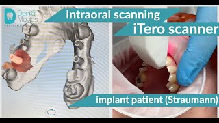 Intraoral scanning using the iTero scanner of an implant patient Straumann [upl. by Gwyn35]