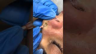 Super Satisfying Blackhead Removal Part 13 blackheads acne oddlysatisfying poping acnebig [upl. by Nnair]