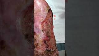 Venous stasis ulceration with pyoderma gangrenosum [upl. by Deana]