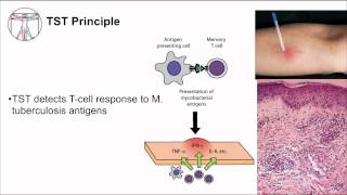 Tuberculosis Diagnosis [upl. by Arias]