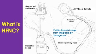 What is HFNC [upl. by Assenat]