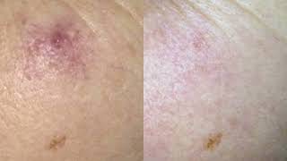 Cherry Angioma removal quick and easy with NDyag laser technology [upl. by Durrace806]