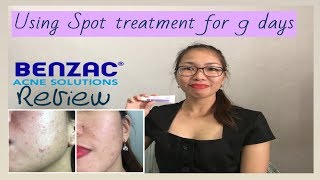 Benzac Benzoyl Peroxide 5 Review  Using spot treatment in 9 Days [upl. by Agrippina]