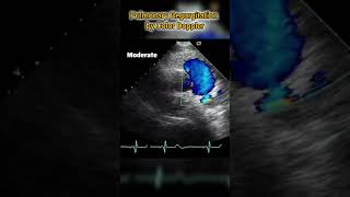 Pulmonary Valve Insufficiency estimation by color doppler Echocardiography [upl. by Asalocin]