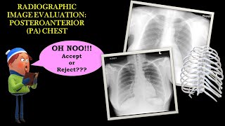 Image Evaluation of PA chest Xray [upl. by Hedy]