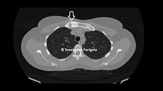 SAPHO syndrome  CT Chest [upl. by Phippen]