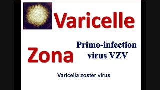 La Varicelle et le zona Chez ladulte les symptomes de la maladie virale des lesions cutanées [upl. by Koerlin]