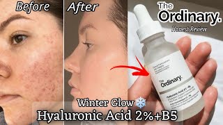 The Ordinary Hyaluronic Acid 2 B5 Serum Honest Review Winter skincare Best Serum For Winters [upl. by Tychon]