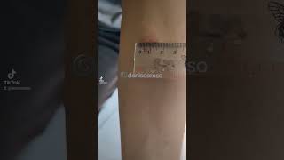 mantoux test positive lebih dari 10mm [upl. by Corrina213]