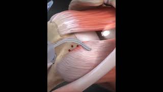 Subscapularis tendon tear  animationshorts shortsfeed youtubeshorts viralshorts [upl. by Rosemonde]