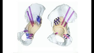 Custom Triflanged Acetabular Reconstruction [upl. by Hildegard]