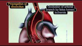 Physiopathology of aortic dissection [upl. by Agarhs]