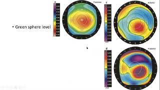 Corneal topography basic interpretation [upl. by Crooks]