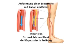 Aufdehnung einer verengten Beinarterie bei Schaufensterkrankheit pAVK [upl. by Angel]